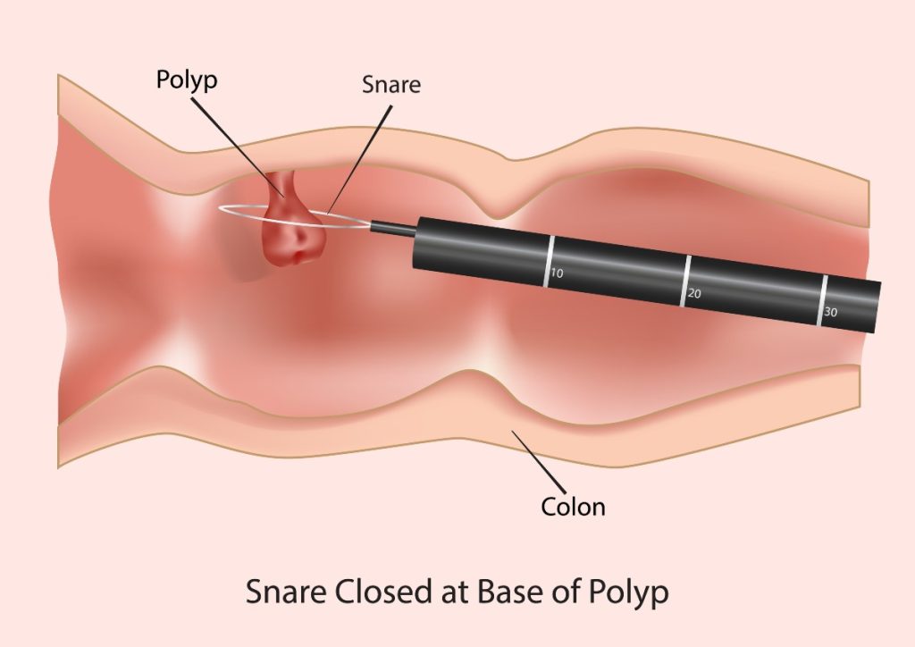 Snare closed at base of polyp
